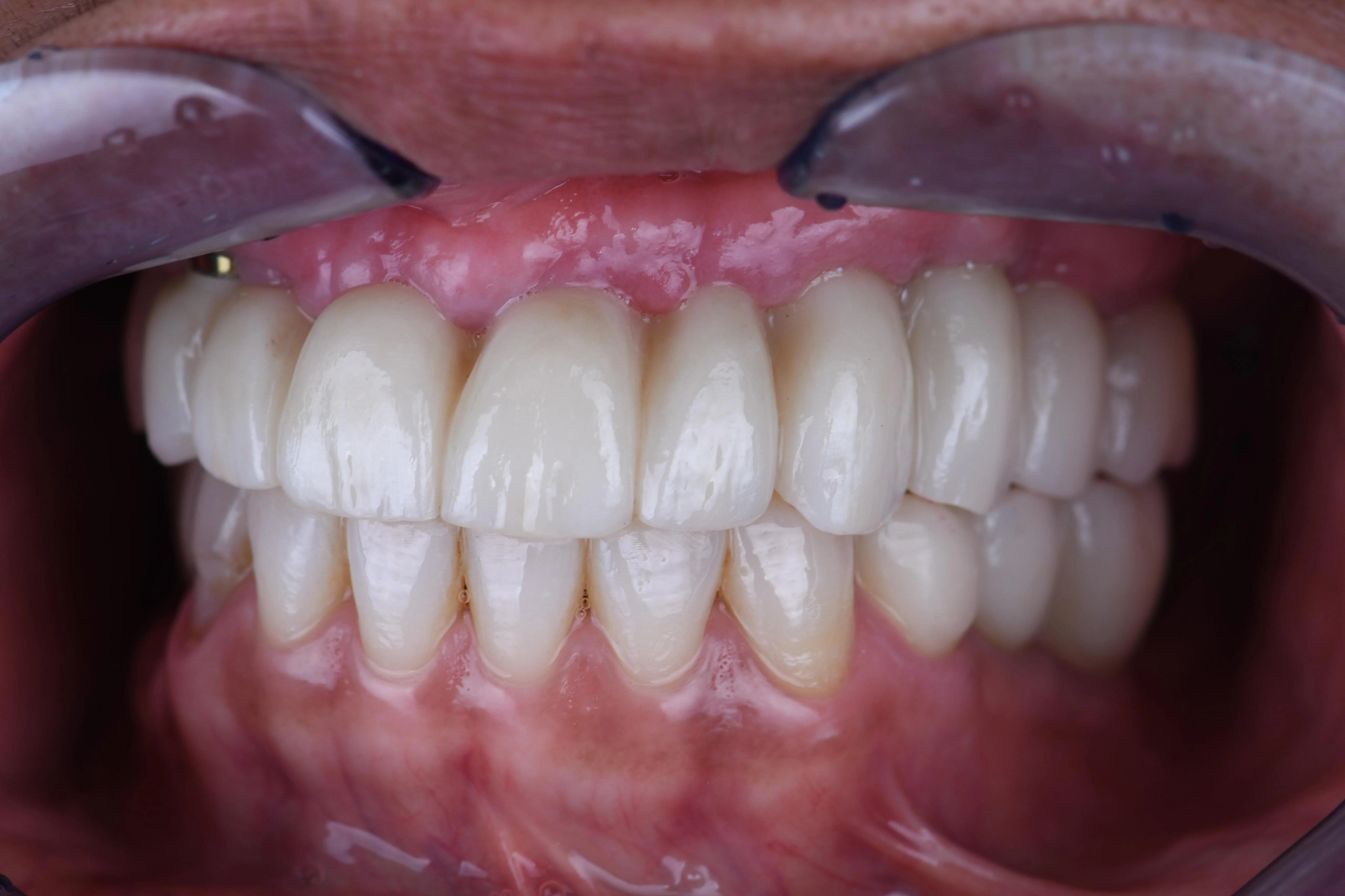 Veneers — result after treatment