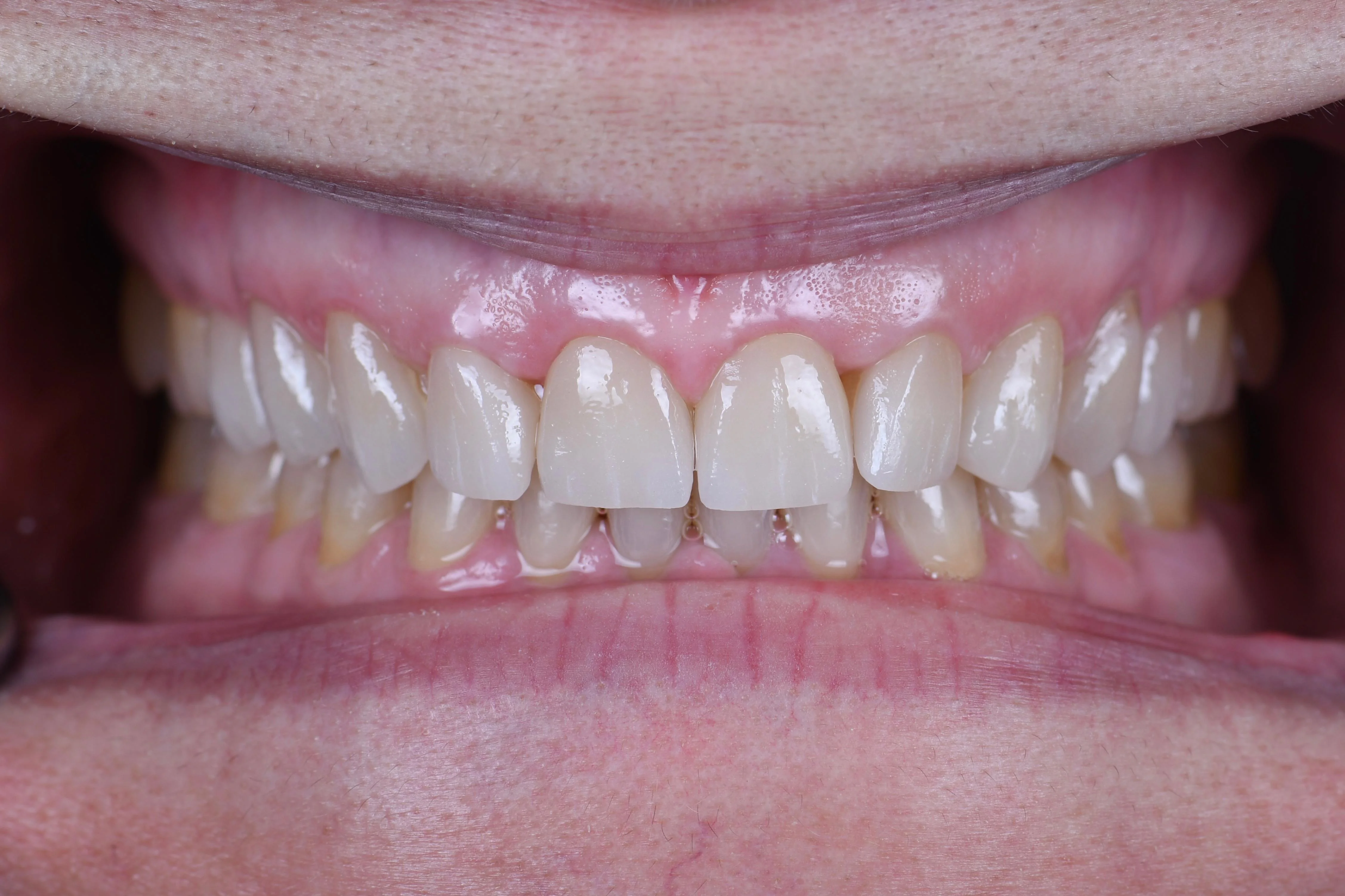Veneers — clinical detail