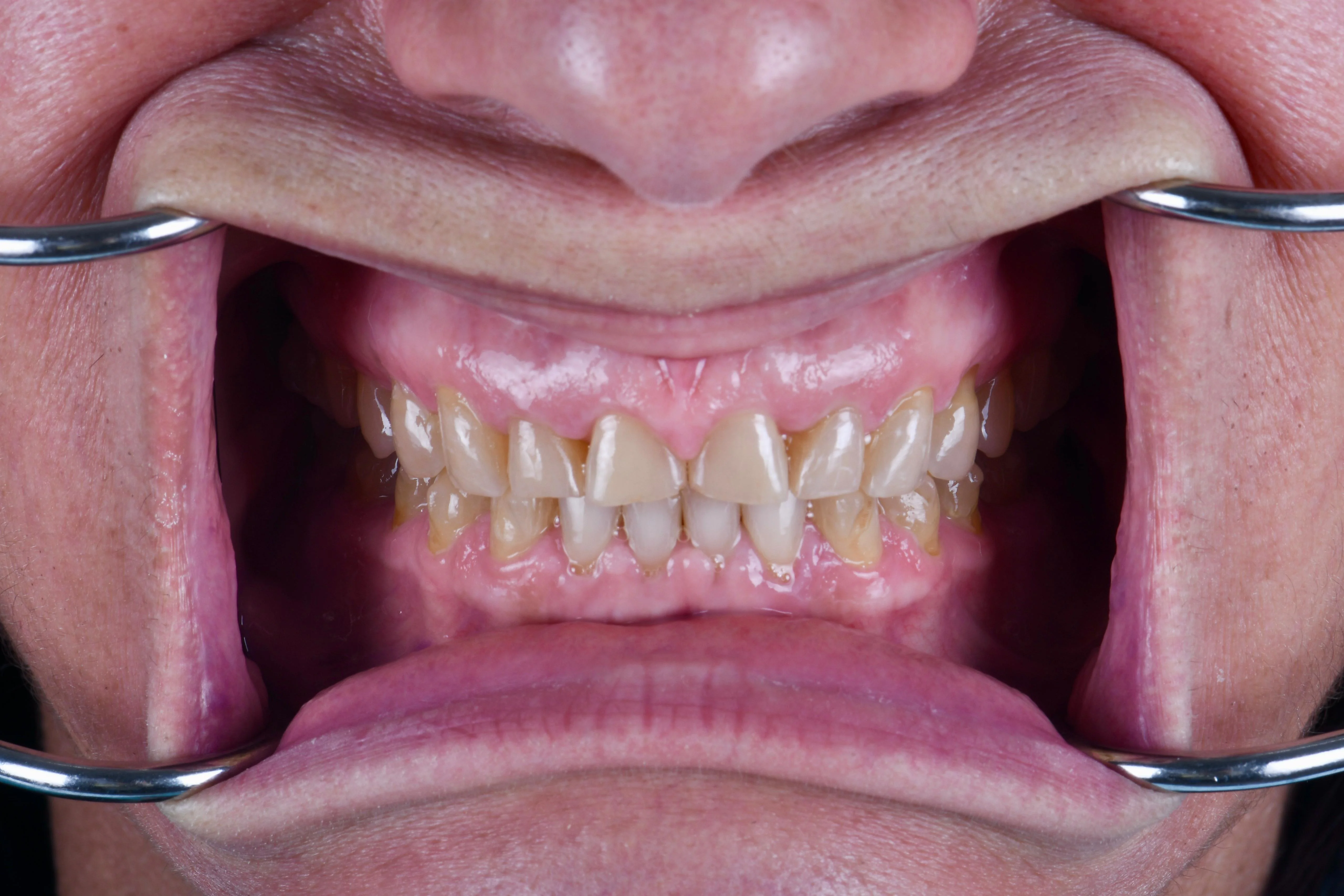 Veneers — before treatment