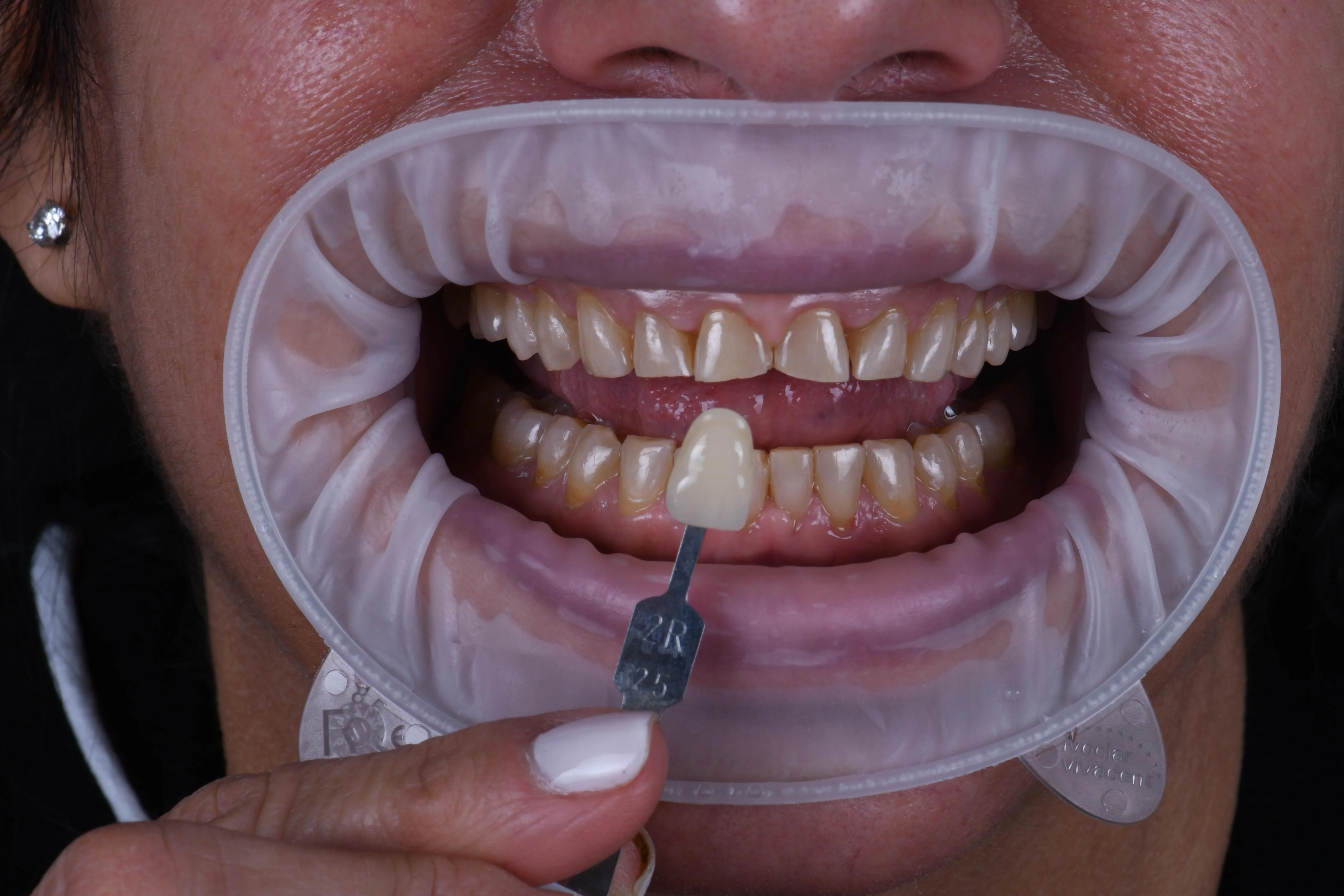Veneers — treatment process